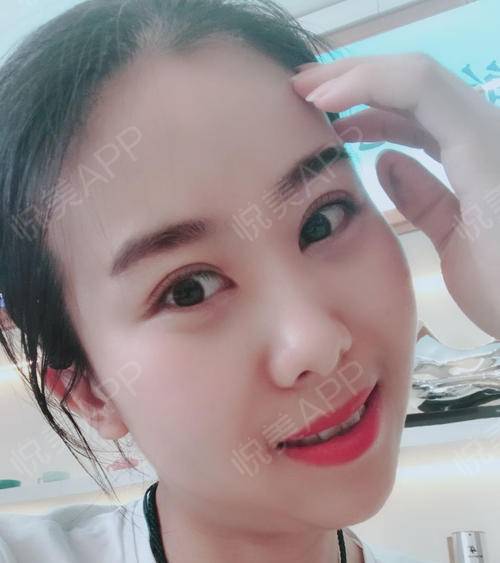 眼睛一點點恢復(fù)，越來越好看 眼部多項手術(shù)的蛻變之旅